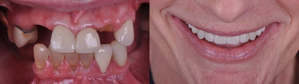 carolinas-center_oral-surgery_dental-implants-4