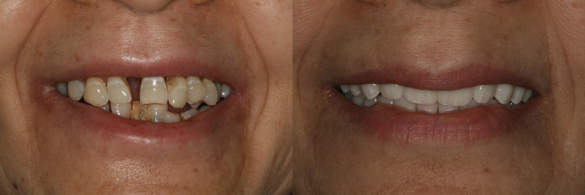 envision-dental-implant-center_full-arch-restoration_2_patient12