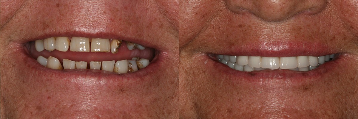 envision-dental-implant-center_full-arch-restoration_2_patient13