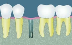 blog-a-guide-to-dental-implants-step1