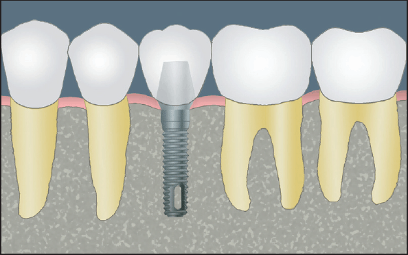 blog-a-guide-to-dental-implants