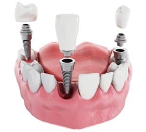 blog-types-of-dental-implants-2